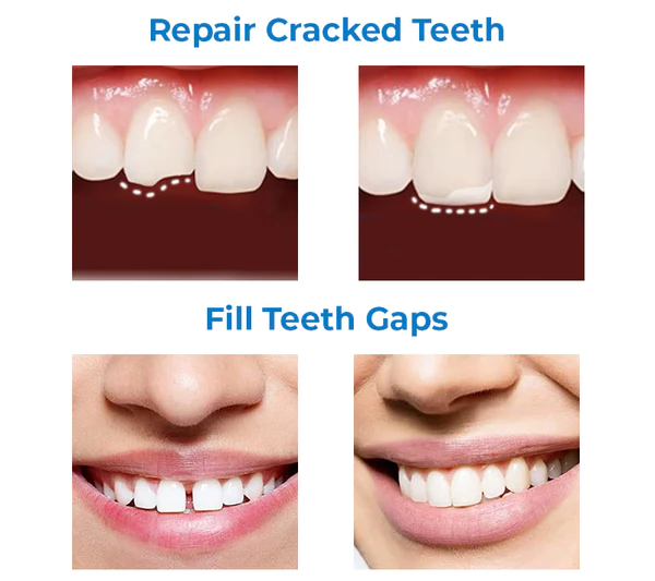 Unpree™ Temporary Moldable False Tooth 