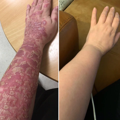 Cvreoz® Bee Venom Psoriasis Treatment Cream