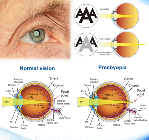 Fivfivgo™ OptiVision Eye Disorders Treatment Eye Drops
