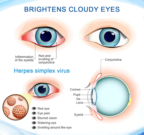 Fivfivgo™ OptiVision Eye Disorders Treatment Eye Drops