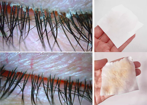 Fivfivgo™ Tea Tree Terpineol Wipes foar it fuortheljen fan oogmyten