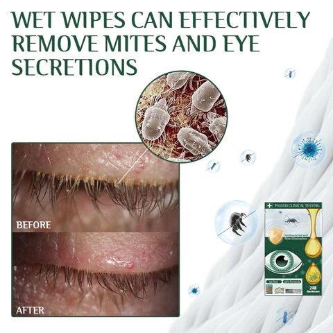 Fivfivgo™ Tea Tree Terpineol Wipes foar it fuortheljen fan oogmyten