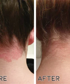 Fivfivgo™ Ätherisches Öl zur Psoriasis-Kur