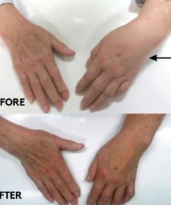 Fivfivgo™ Carpal Tunnel Treatment Device