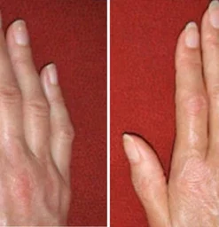 Fivfivgo™ Carpal Tunnel Treatment Device