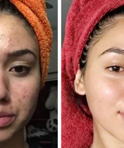 Fivfivgo™ ClariFace Overnight Acne Patches