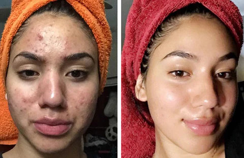 Fivfivgo™ ClariFace Overnight Acne Patches