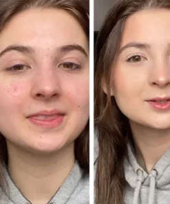 Fivfivgo™ ClariFace Overnight Acne Patches