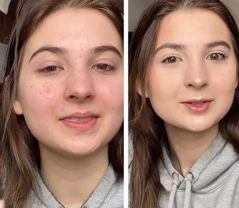 Fivfivgo™ ClariFace Overnight Acne Patches