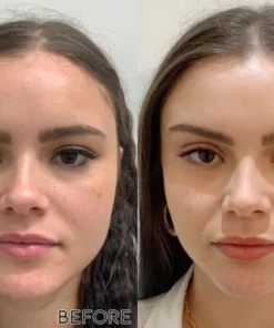 Fivfivgo™ Mini-Mikrostrom-Gerät zur Gesichtsstraffung