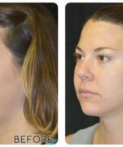 Fivfivgo™ Mini-Mikrostrom-Gerät zur Gesichtsstraffung