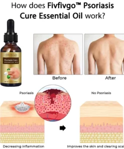 Fivfivgo™ Psoriasis Cure Essential Oil