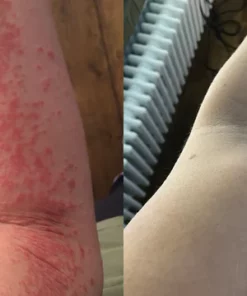 Fivfivgo™ Psoriasis Cure Essential Oil