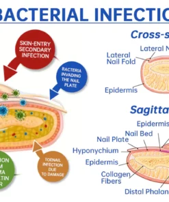 Fivfivgo™ PureNail Fungus Laser Therapie Gerät