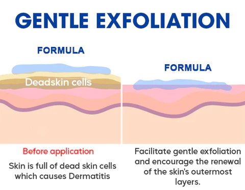 Fivfivgo™ Seborrheic Dermatitis Cream