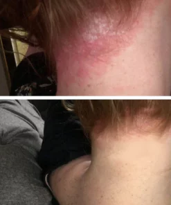 Fivfivgo™ Seborrheic Dermatitis Cream