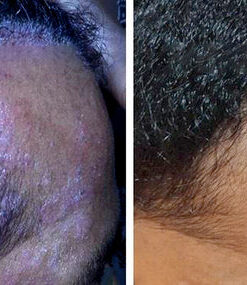 Fivfivgo™ Seborrhoische Dermatitis Creme