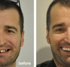 Fivfivgo™ Shark Cartilage Protein Dental Regrowth Drops