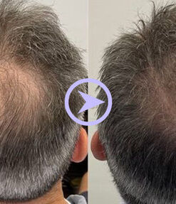 Fivfivgo™ SootheScalp Pro Massagebürste