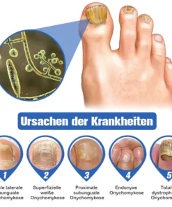 Furzero™ Nagelpilz-Laserbehandlungsgerät