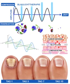 Furzero™ Nagelpilz-Laserbehandlungsgerät