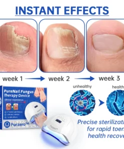 Furzero™ PureNail Fungus Laser Therapy Device