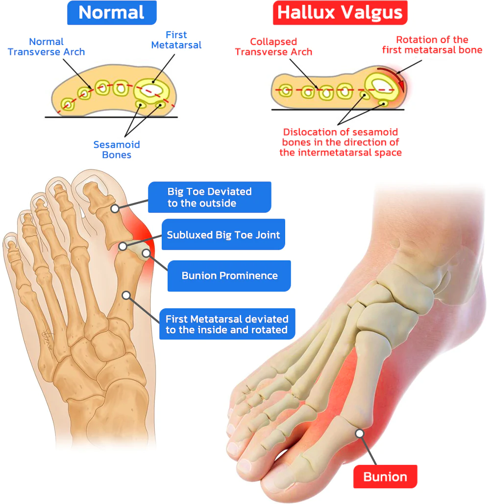 GFOUK™ HealthToe Joint Correcter Pressionspflaster