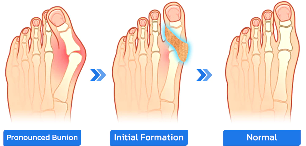 GFOUK™ HealthToe Joint Correcter Pressionspflaster