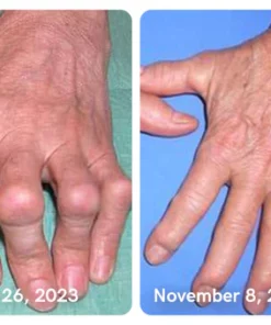 GFOUK™ Collagenase and Bone Therapy Cream