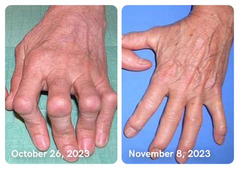 GFOUK™ Collagenase and Bone Therapy Cream