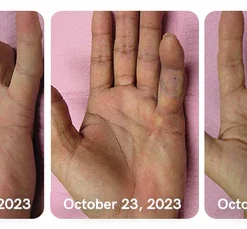 GFOUK™ Collagenase and Bone Therapy Cream