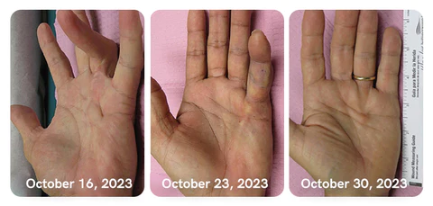 GFOUK™ Collagenase and Bone Therapy Cream