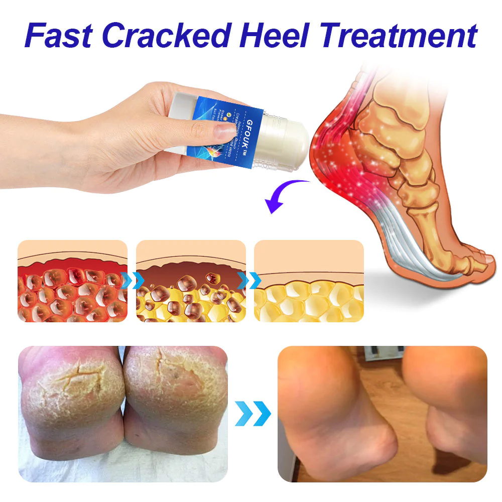 Healing cream sales for cracked heels