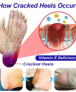 GFOUK™ Intensive Repair Cream For Cracked Heels