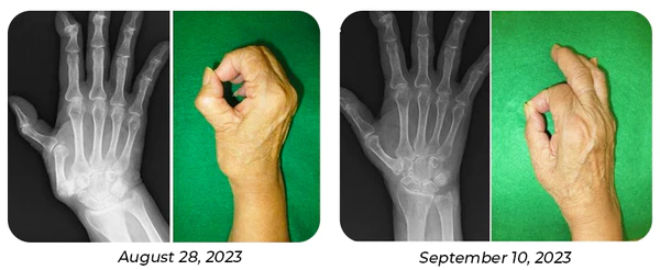 GFOUK™ MedicWave Thermal Laser Joint Care Pen