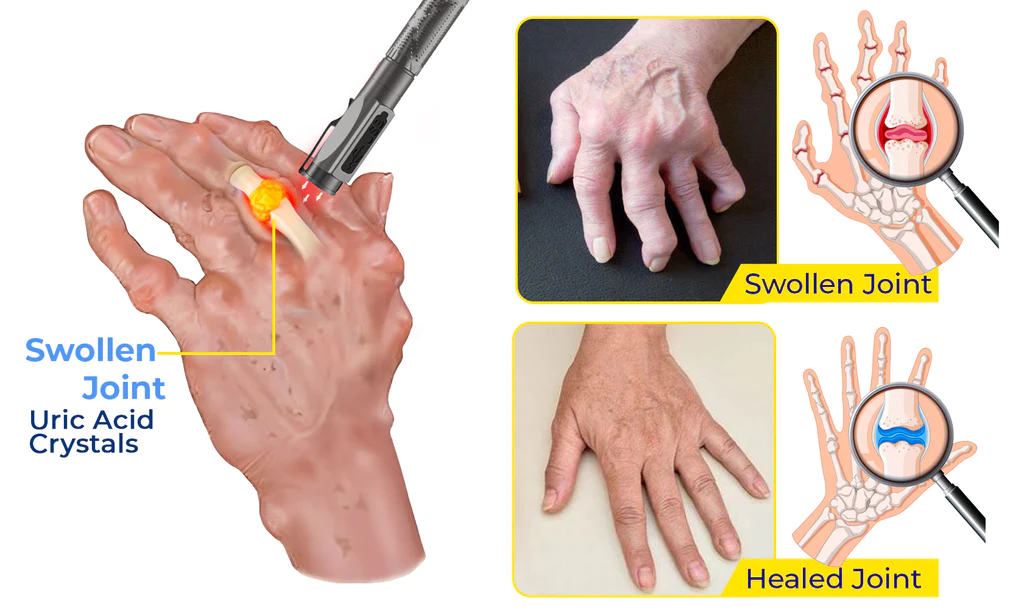 GFOUK™ MedicWave Thermal Laser Joint Care Pen