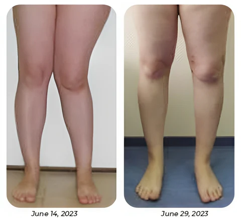 GFOUK™ MedicWave Thermal Laser Joint Care Pen