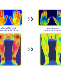 GFOUK™ MedicWave Thermal Laser Joint Care Pen