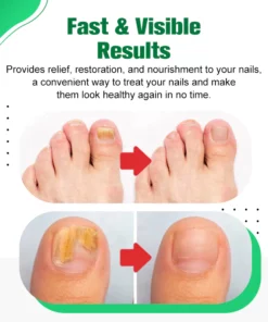 HerbNail™ Toenail Fungus Care Antibacterial Solution