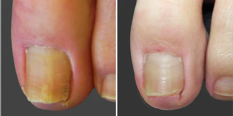 HerbNail™ Toenail Fungus Care Antibacterial Solution
