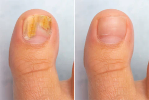 HerbNail™ Toenail Fungus Care Antibacterial Solution
