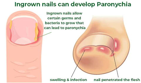 HerbNail™ Toenail Fungus Care Antibacterial Solution
