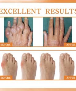 LIMETOW™ New Zealand Bee Venom Professional Treatment Spray