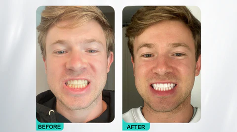 LIMETOW™ Teeth Whitening Spray