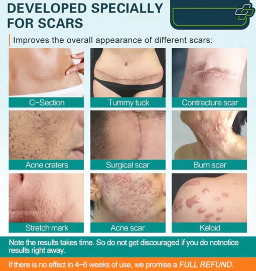 LOVILDS™ Advanced Scar Spray para todos os tipos de cicatrizes