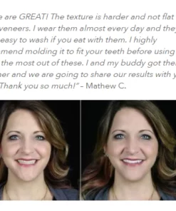 Nurbini™Adjustable Snap-On Dentures