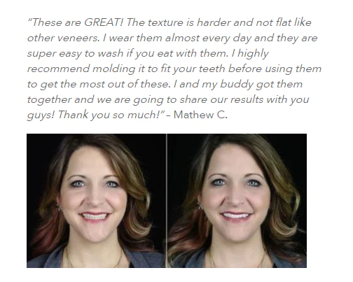 Nurbini™Adjustable Snap-On Dentures