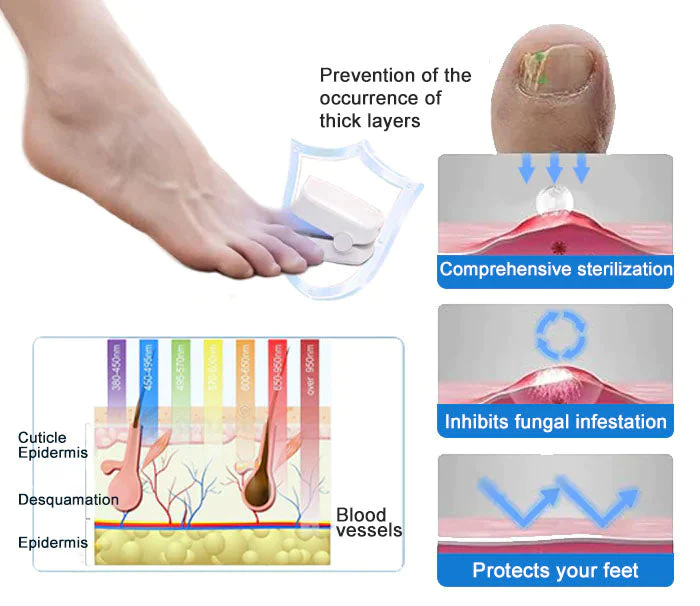 Ourlyard™ Efficient Light Therapy Device for the Treatment of Nail Disorders