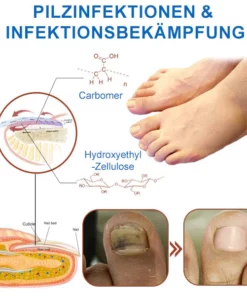 Ourlyard™ Effizientes Lichttherapiegerät zur Behandlung von Nagelerkrankungen