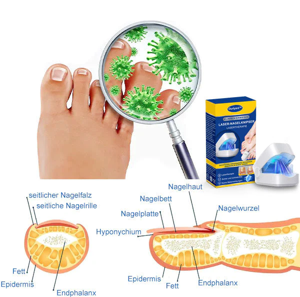 Ourlyard™ Effizientes Lichttherapiegerät zur Behandlung von Nagelerkrankungen